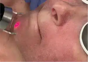 co2 laser treatment