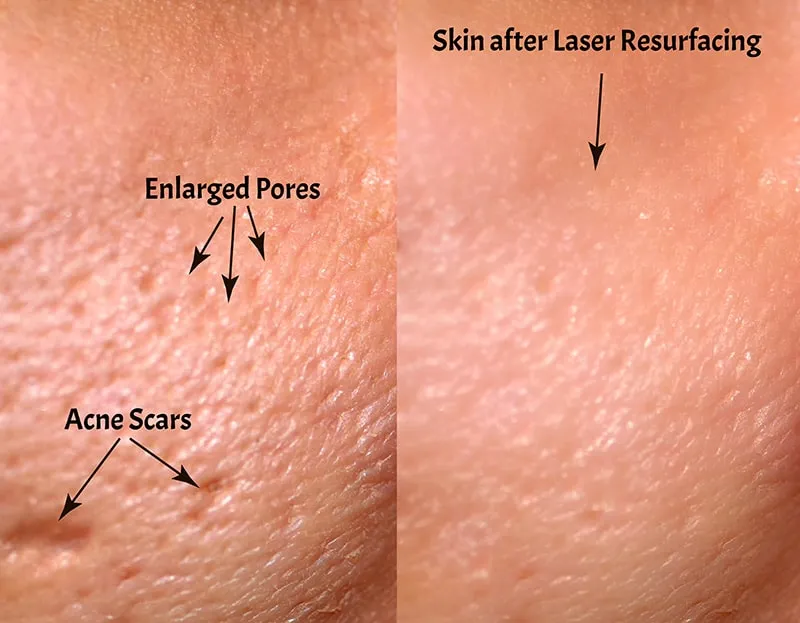 laser resurfacing diagram