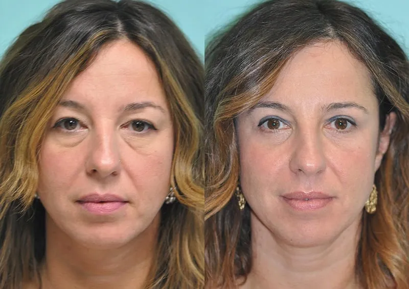 laser treatments ba 3