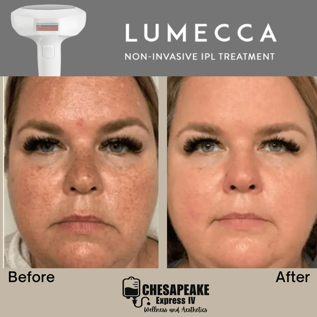 lumecca before and after instagram post 2