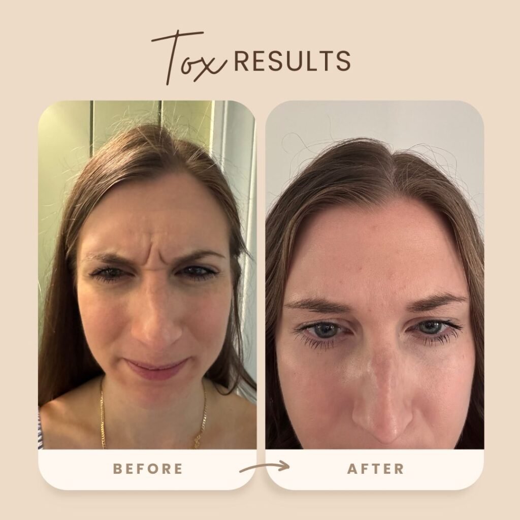 Before and after toxin treatment results