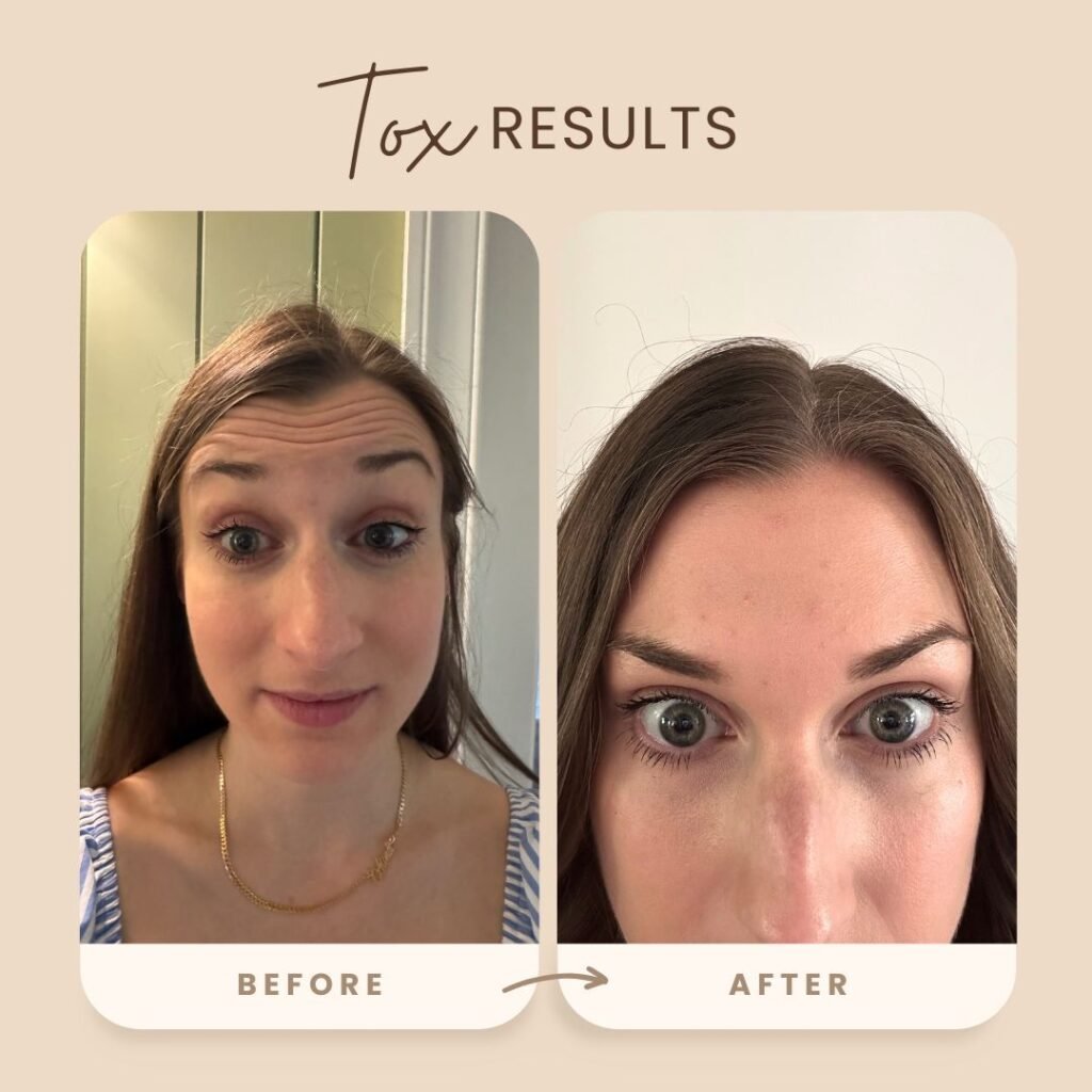 Before and after Botox results on forehead wrinkles.