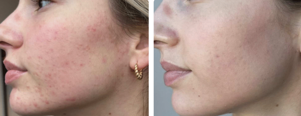 Before and after acne treatment comparison.