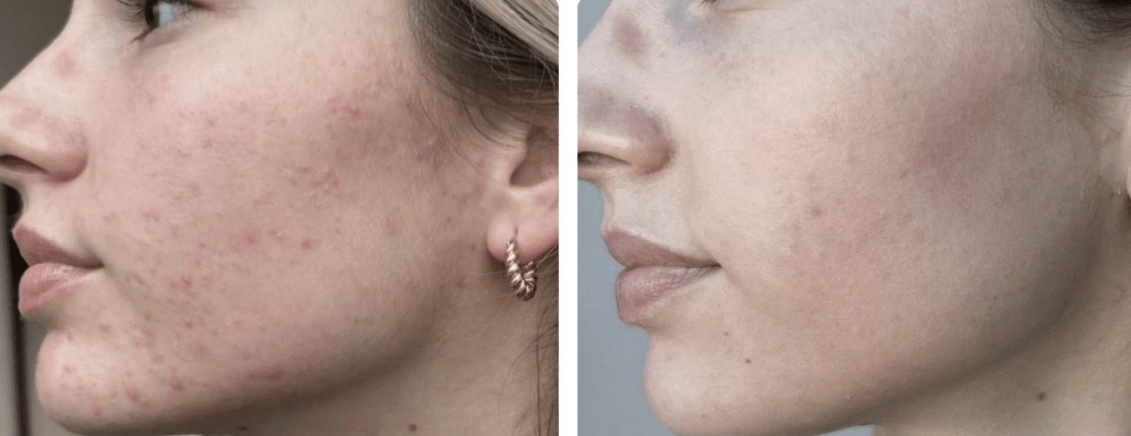 Before and after acne treatment comparison.