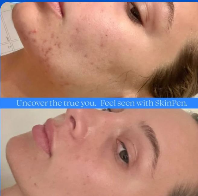 Before and after SkinPen acne treatment results.