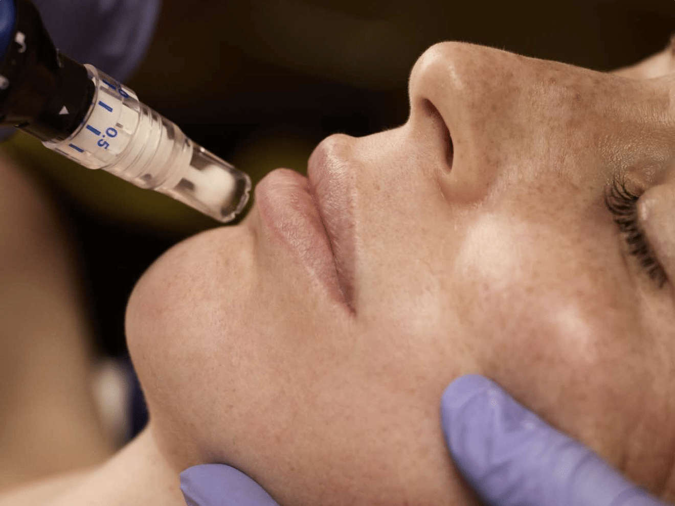 Person receiving skin treatment with handheld device annapolis md facials