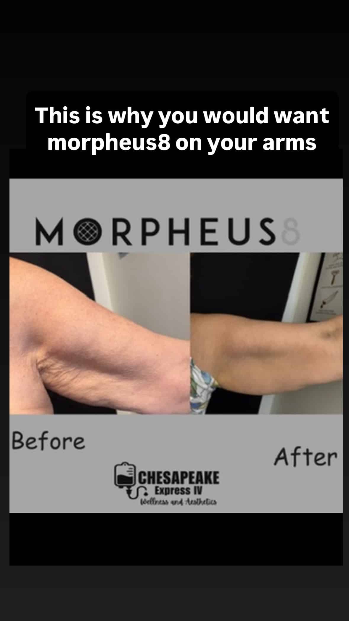Morpheus8 arm treatment before and after results.