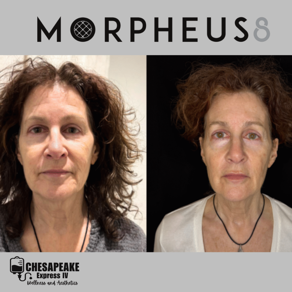 Morpheus8 before and after treatment comparison