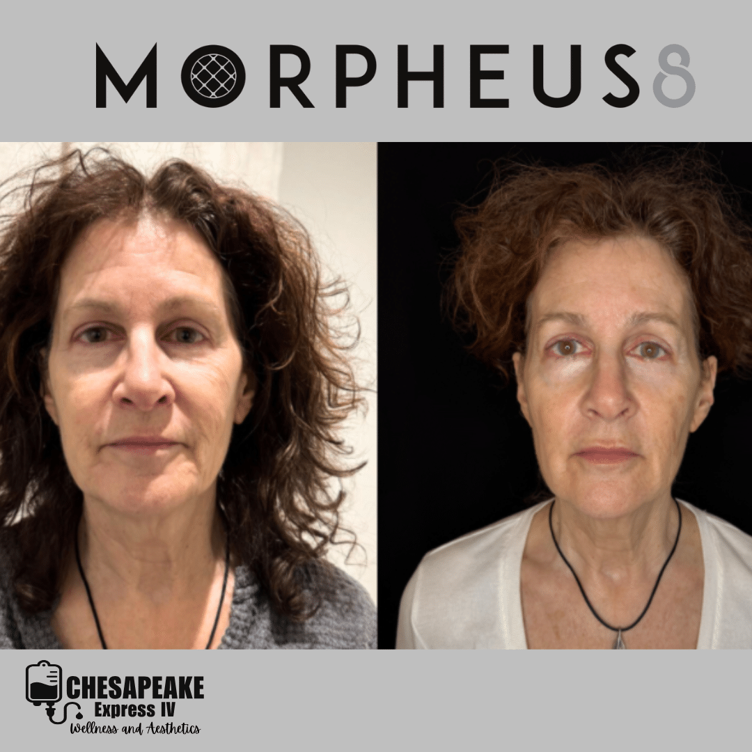 Morpheus8 before and after treatment comparison