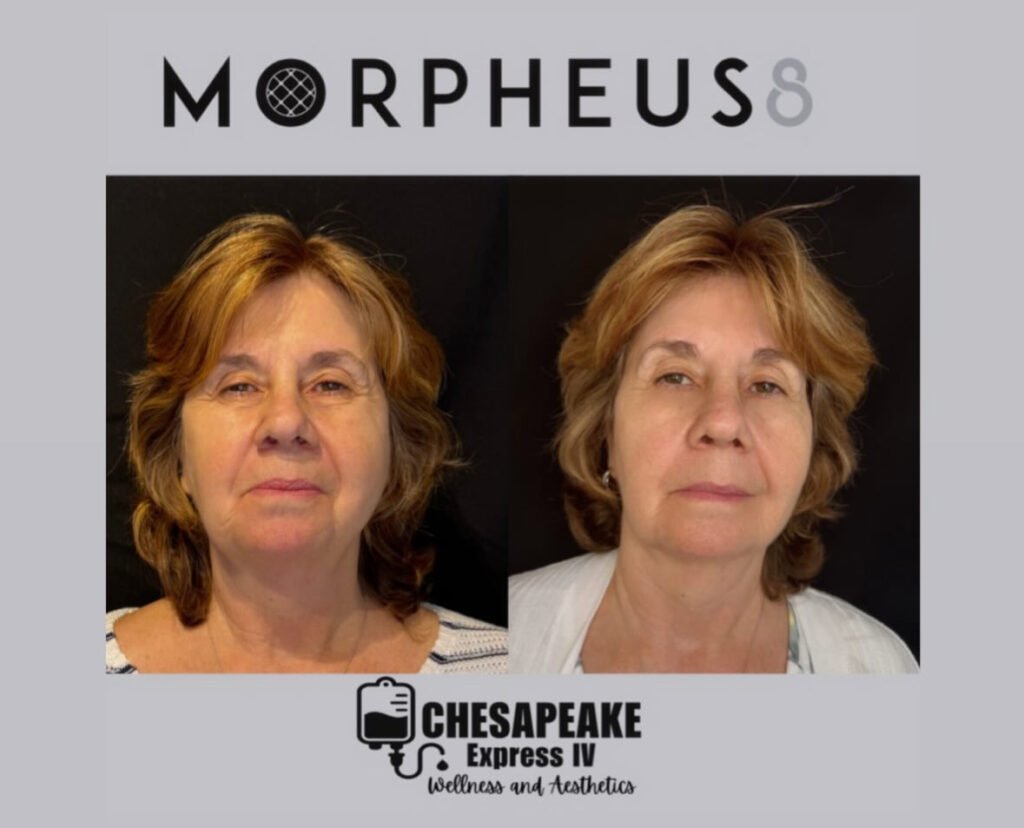 Morpheus8 facial treatment before and after results.