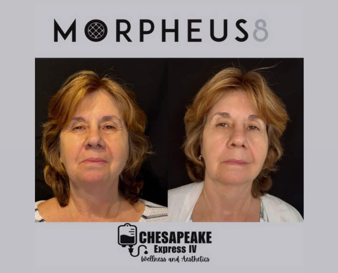 Morpheus8 facial treatment before and after results.