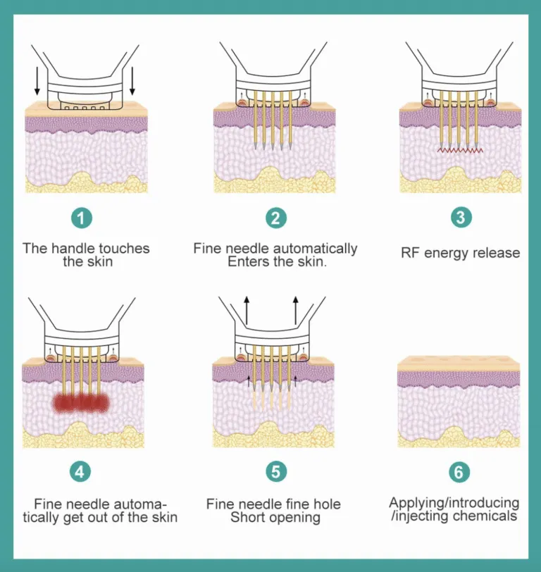 RF micro-needling skin treatment