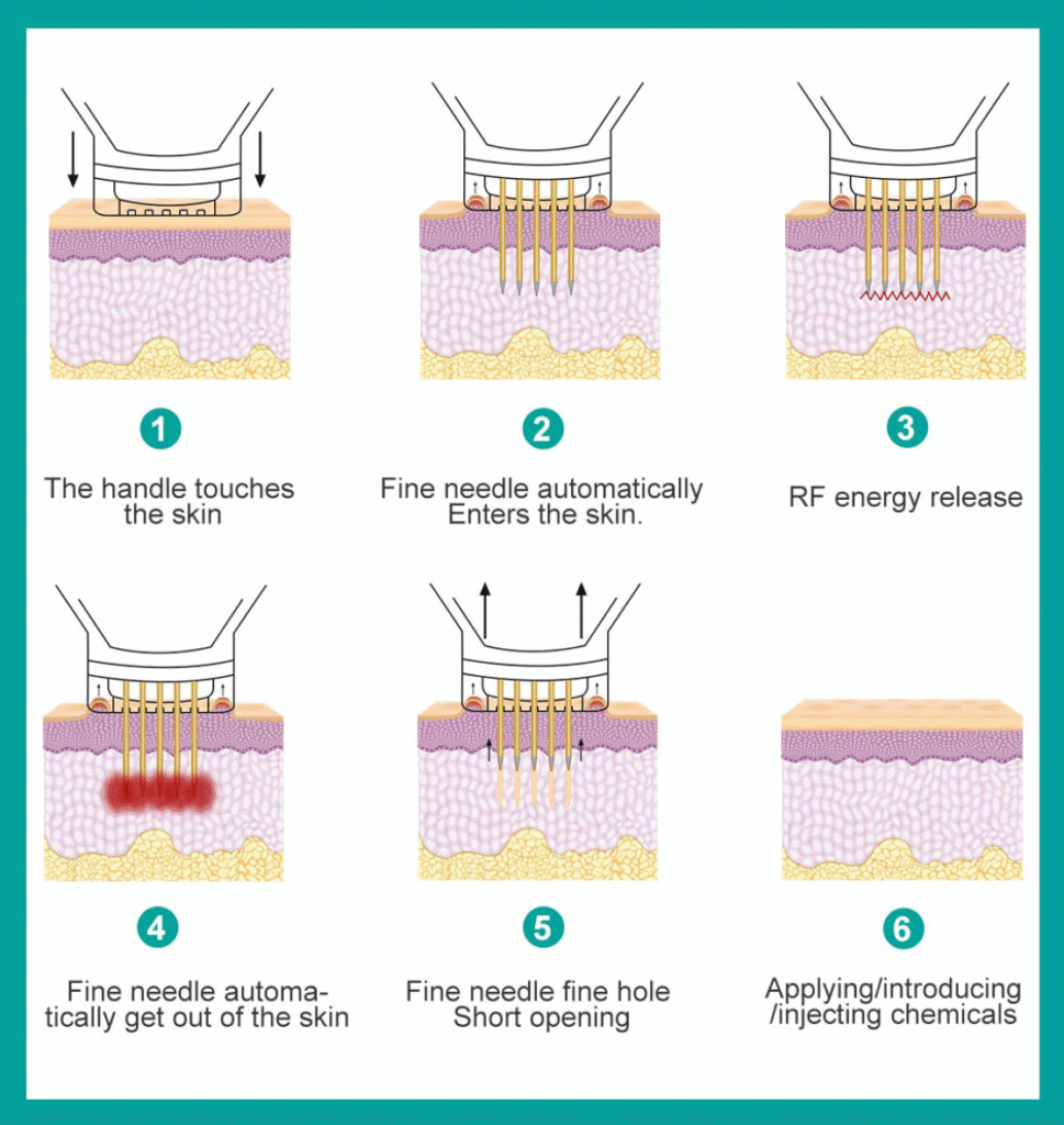 RF micro-needling skin treatment