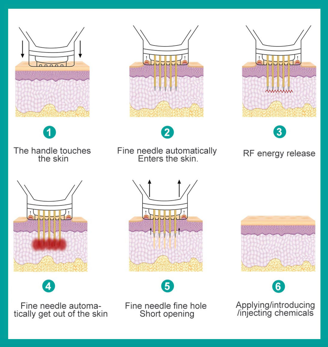RF micro-needling skin treatment