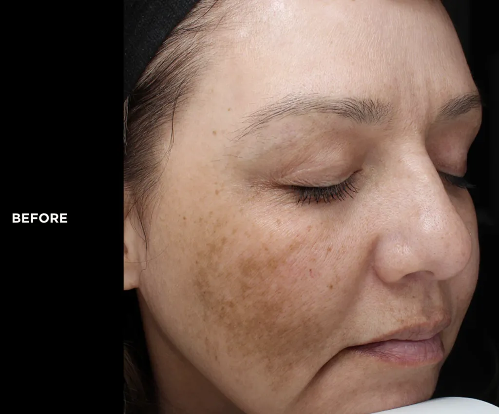 Close-up of woman's face with skin discoloration.