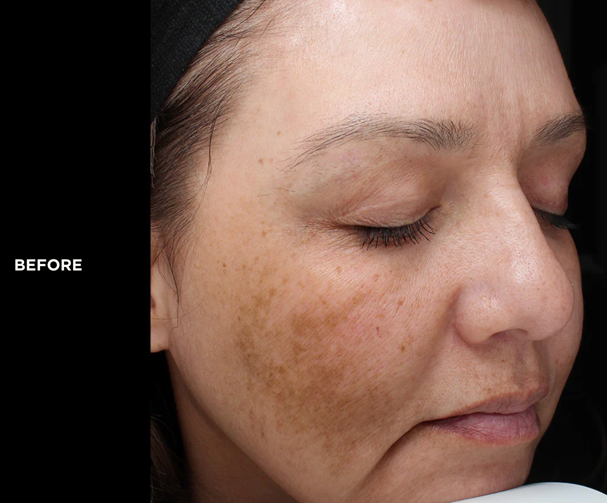 Close-up of woman's face with skin discoloration.