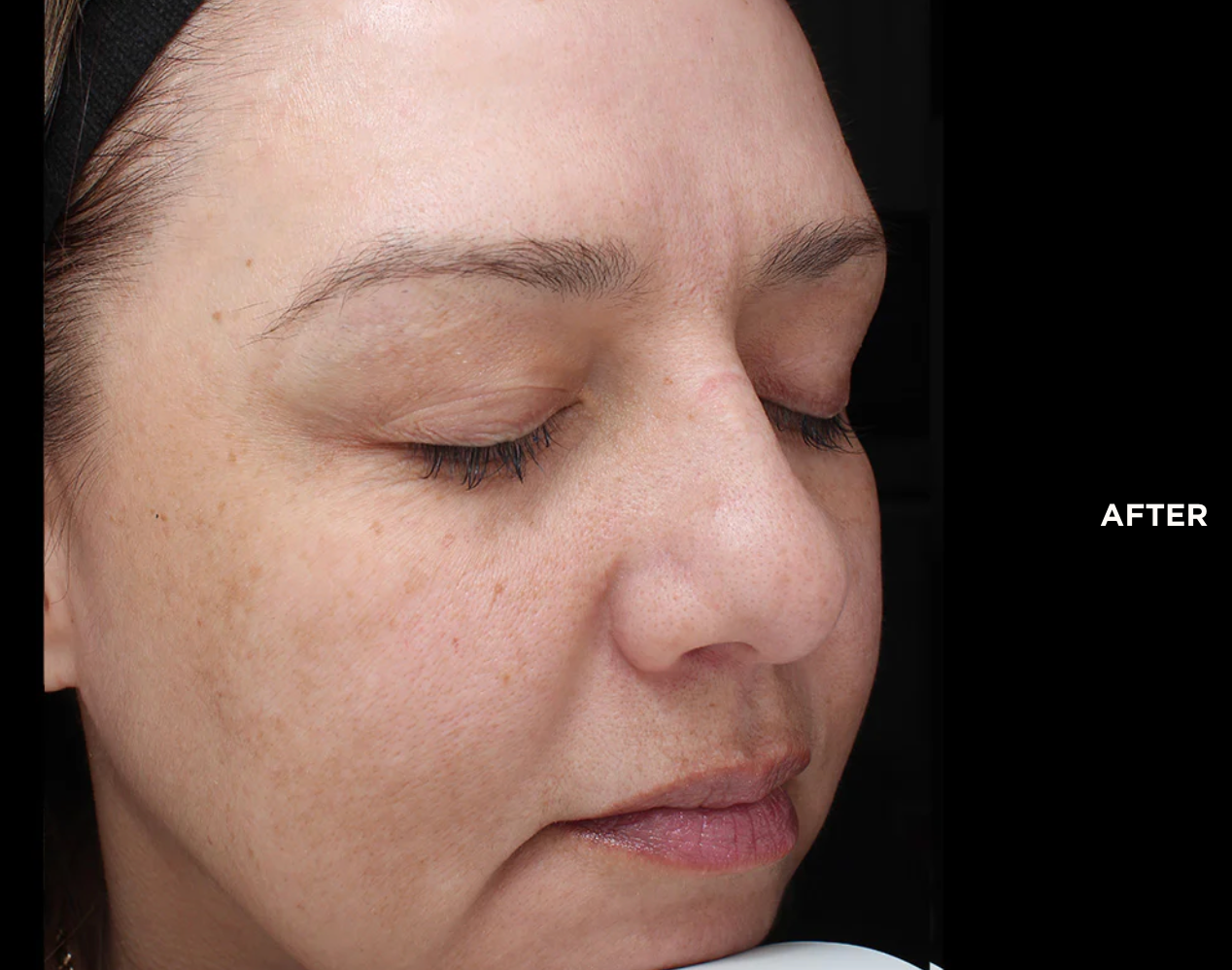 vi chemical peel before and after annapolis md Precision Plus with Peptides chemical peel