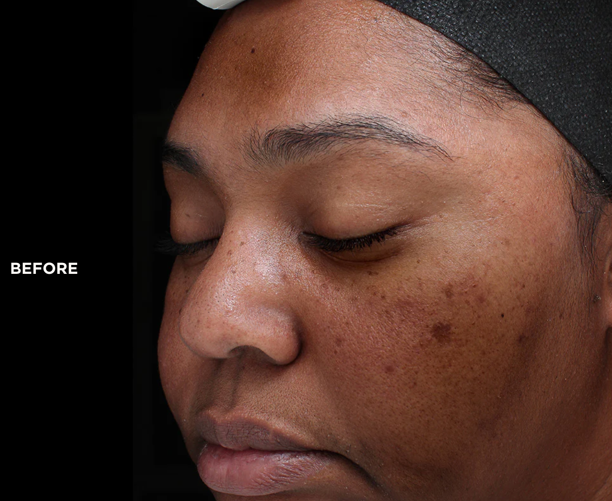 Purify Precision Peptides peel combines