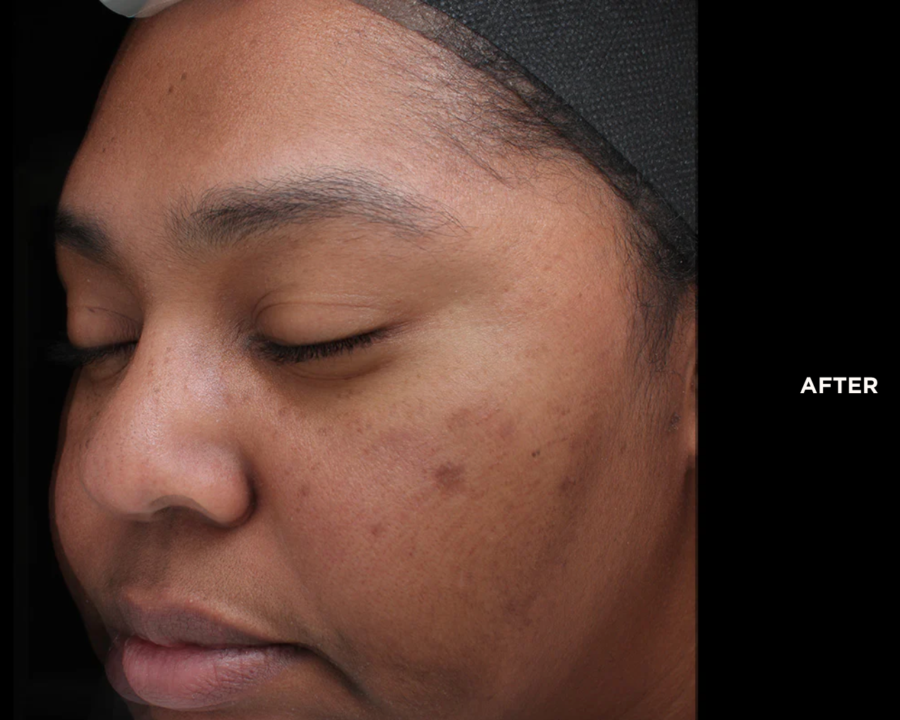 Purify Precision Peptides Peel VI Chemical Peel Annapolis MD