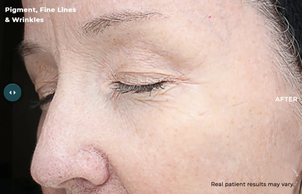 Close-up of woman's face after wrinkle treatment.