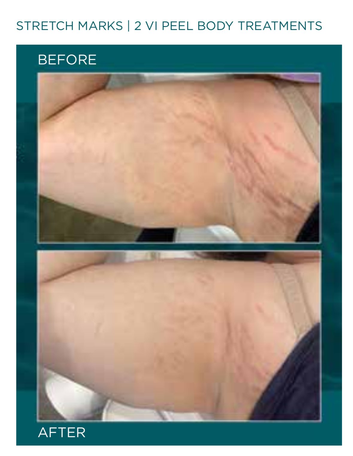 Before and after VI Peel treatment results - Annapolis MD