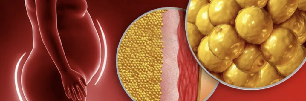 Illustration of cellulite and subcutaneous fat cells