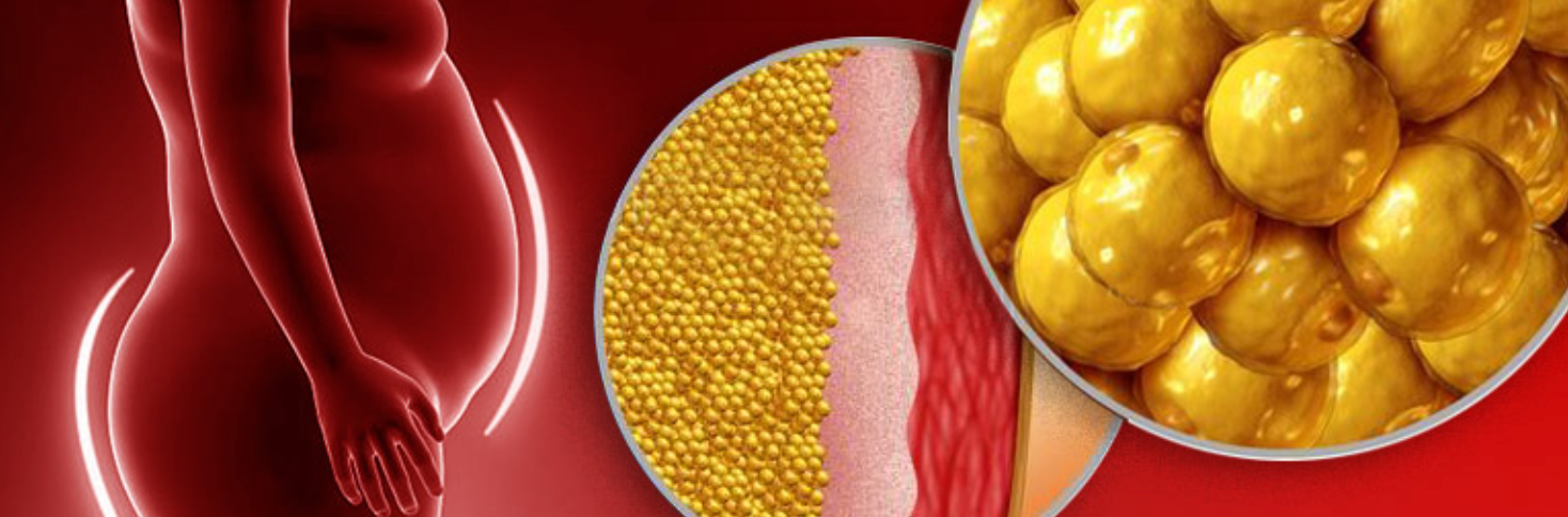 Illustration of cellulite and subcutaneous fat cells
